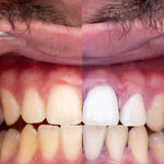 PURPLE V34 - Blanqueador Dental